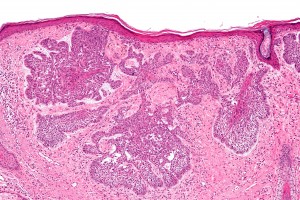 Basal_cell_carcinoma_-_2_-_intermed_mag