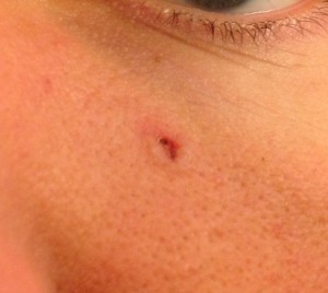 My own little basal cell carcinoma, just below my left eye. Hurray.